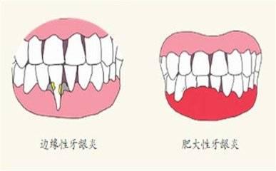 为什么会得牙龈炎？牙龈炎长期不治疗会有什么后果？