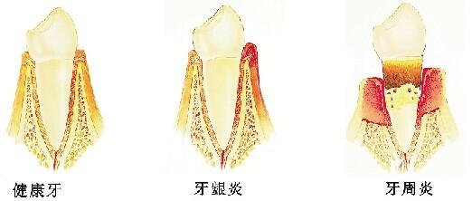出现这4种情况，小心是牙周病的信号！